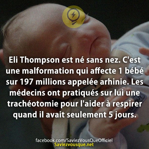Eli Thompson est né sans nez. C&#039;est une malformation qui affecte 1 bébé sur 197 millions appelée arhinie. Les médecins ont pratiqués sur lui une trachéotomie pour l&#039;aider à respirer quand il avait seulement 5 jours.