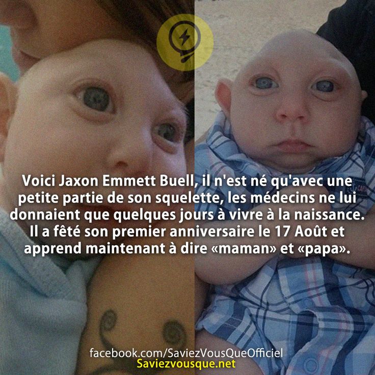 Voici Jaxon Emmett Buell, il n&#039;est né qu&#039;avec une petite partie de son squelette, les médecins ne lui donnaient que quelques jours à vivre à la naissance. Il a fêté son premier anniversaire le 17 Août et apprend maintenant à dire «maman» et «papa».