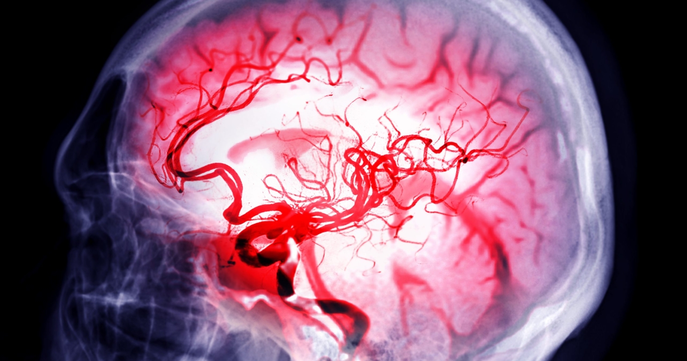 Urgence invisible : reconnaître et agir face à un AVC ou un ICT, la minute qui sauve une vie