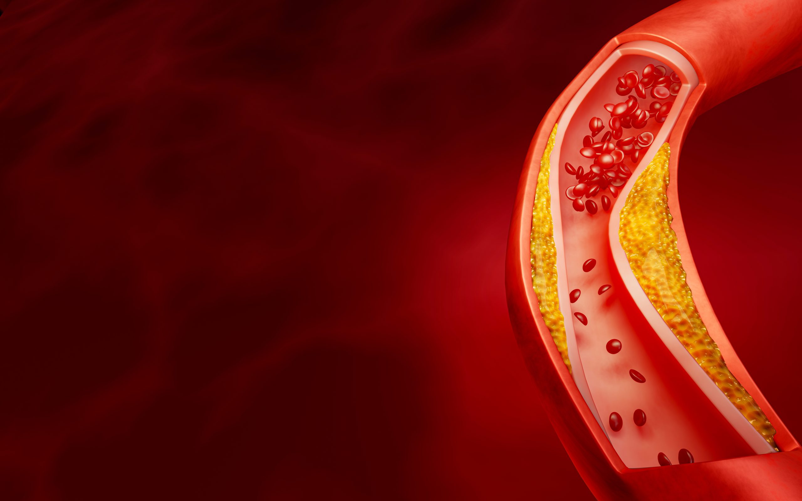 Les origines insoupçonnées de l'accumulation du cholestérol LDL