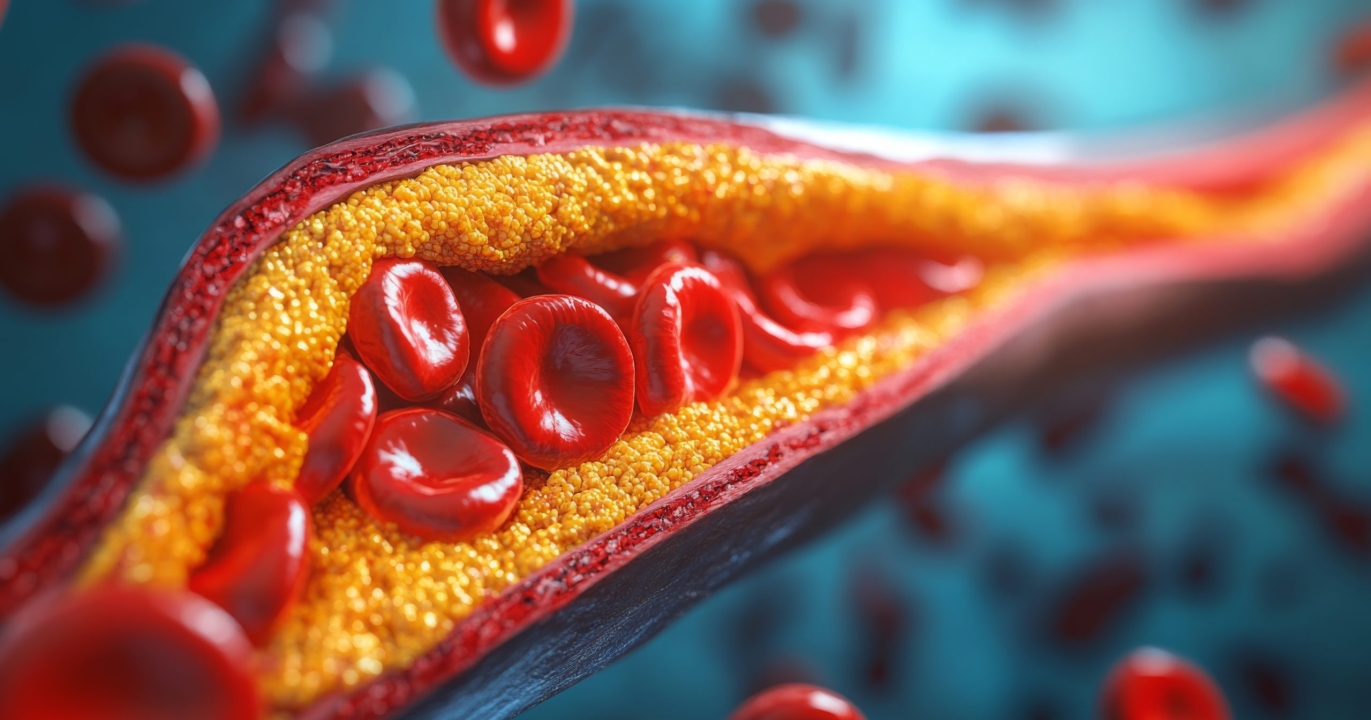 Le piège silencieux du mauvais cholestérol : comprendre l’ennemi invisible