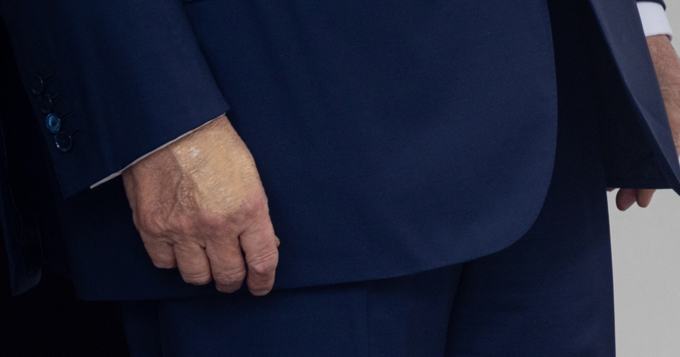 Les mains de Donald Trump deviennent virales alors que de grandes taches de « fond de teint » apparaissent